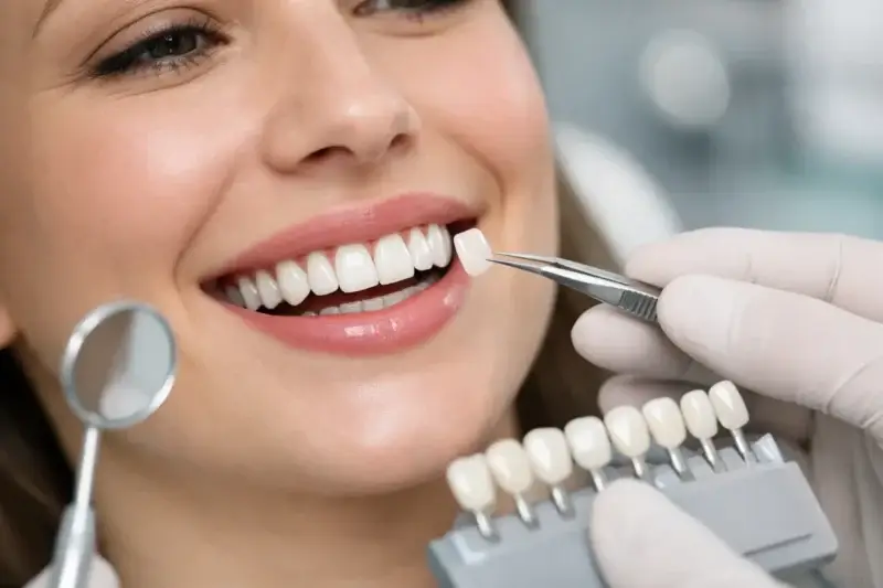 خطوات تركيب عدسات الأسنان لابتسامة طبيعية